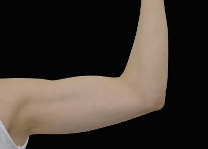 Emsculpt_neo_PIC_028-after-arms-female-Bruce-E-Katz-MD-3M__412x296px_1602658160_original_New