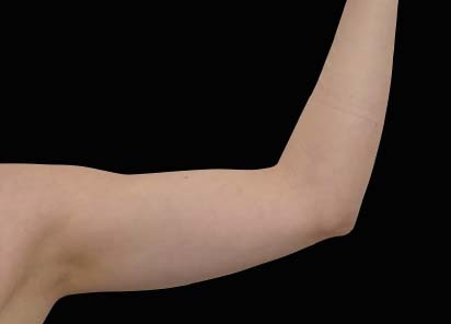 Emsculpt_neo_PIC_028-before-arms-female-Bruce-E-Katz-MD__412x296px_1602658162_original_New