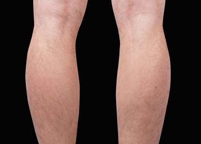 Emsculpt_neo_PIC_030-before-calves-male-Bruce-E-Katz-MD__412x296px_1602680599_original_New