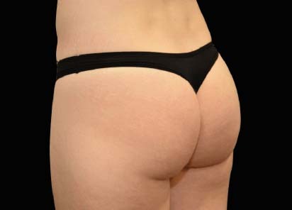 Emsculpt_Neo_PIC_045-after-last-tx-buttock-female-Klaus-Hoffman-MD_412x296px_1616750975_original