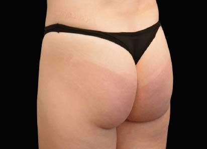 Emsculpt_Neo_PIC_045-before-buttock-female-Klaus-Hoffman-MD_412x296px_1616750977_original