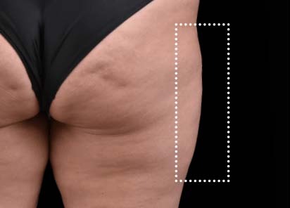 Emsculpt_Neo_PIC_060-before-outer_thighs-female-BTL-Aesthetics-412x296px_1621339709_original_New