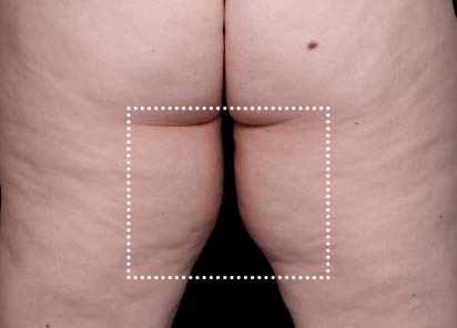 Emsculpt_Neo_PIC_062-after-inner_thighs-female-Diane-Duncan-MD-1M_412x296px_1621339714_original_New