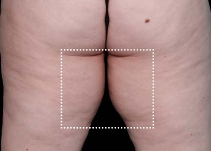 Emsculpt_Neo_PIC_062-before-inner_thighs-female-Diane-Duncan-MD_412x296px_1621339719_original_New