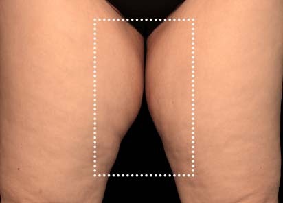 Emsculpt_Neo_PIC_063-before-inner_thighs-female-Diane-Duncan-MD_412x296px_1621339728_original_New