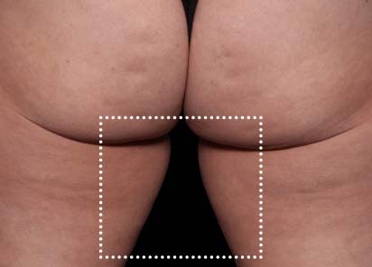 Emsculpt_Neo_PIC_068-after-inner_thighs-female-Diane-Duncan-MD-1M_412x296px_1621339732_original_New