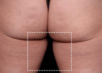 Emsculpt_Neo_PIC_068-before-inner_thighs-female-Diane-Duncan-MD_412x296px_1621339736_original_New