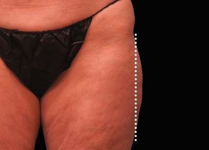 Emsculpt_Neo_PIC_49-after-outer_thighs-female-Brian-Kinney-MD-1M_412x296px_1621339693_original_New