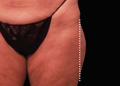 Emsculpt_Neo_PIC_49-before-outer_thighs-female-Brian-Kinney-MD_412x296px_1621339697_original_New