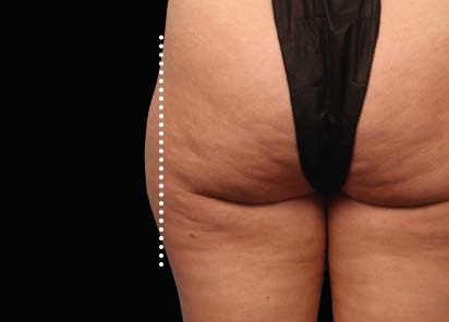 Emsculpt_Neo_PIC_53-after-outer_thighs-female-Melanie-Palm-MD_412x296px_1621339699_original_New