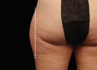 Emsculpt_Neo_PIC_53-before-outer_thighs-female-Melanie-Palm-MD_412x296px_1621339701_original_New