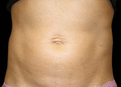 Emsculpt_PIC_008-After-abdomen-female-Katerina-Fajkosova-MD-4TX__412x296px_1589358973_original