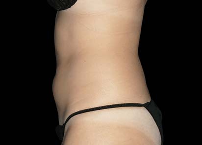 Emsculpt_PIC_010-After-female-Robert-Weiss-MD-6TX__412x296px_1589358977_original