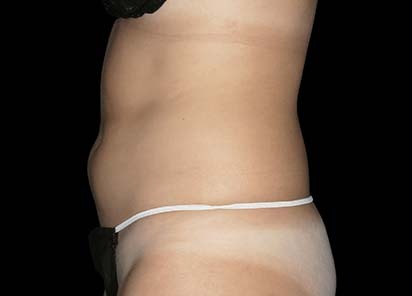 Emsculpt_PIC_010-Before-female-Robert-Weiss-MD__412x296px_1589358979_original