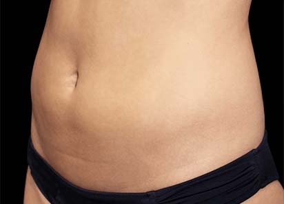 Emsculpt_PIC_011-Before-abdomen-female-Suneel-Chilukuri-MD_412x296px_1589358985_original