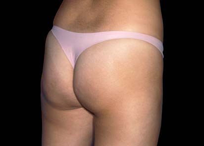 Emsculpt_PIC_012-After-female-Mariano-Busso-MD-4TX__412x296px_1589359159_original_New