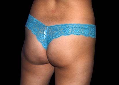 Emsculpt_PIC_012-Before-female-Mariano-Busso-MD__412x296px_1589359161_original_New