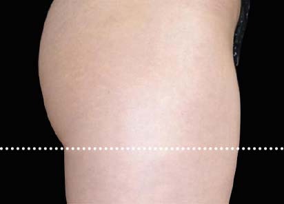 Emsculpt_PIC_015-Before-female-Radina-Denkova-MD__412x296px_1589434576_original_New