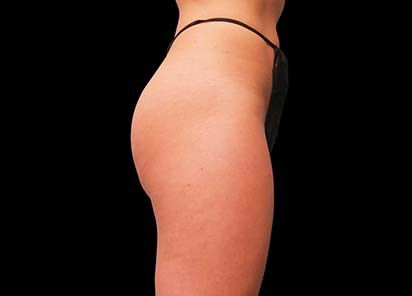 Emsculpt_PIC_016-After-buttock-female-Brian-Kinney-MD-4TX__412x296px_1589434578_original_New