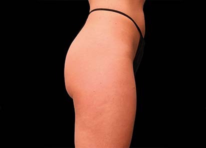 Emsculpt_PIC_016-Before-buttock-female-Brian-Kinney-MD__412x296px_1589434579_original_New