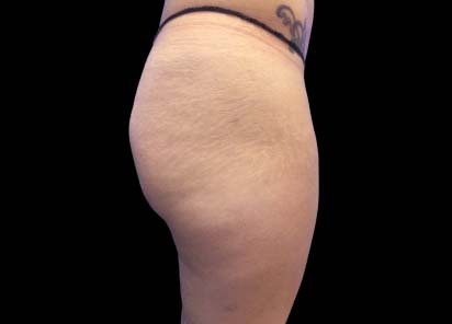 Emsculpt_PIC_017-After-buttock-female-Carolyn-Jacob-MD-4TX_412x296px_1602658241_original