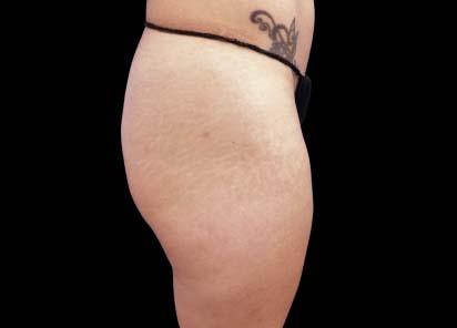 Emsculpt_PIC_017-Before-buttock-female-Carolyn-Jacob-MD_412x296px_1602658243_original