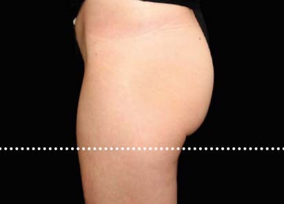 Emsculpt_PIC_020-After-buttock-female-Suneel-Chilukuri-MD-4TX__412x296px_1589434582_original_New