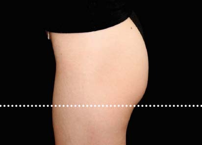 Emsculpt_PIC_020-Before-buttock-female-Suneel-Chilukuri-MD__412x296px_1589434584_original_New