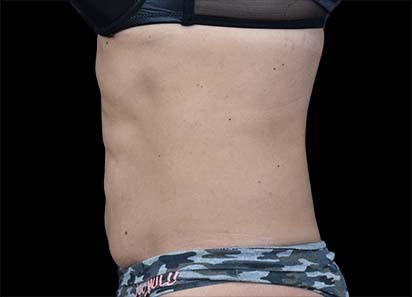 Emsculpt_PIC_022-After-abdomen-female-Paula-Lozanova-MD-4TX__412x296px_1589358992_original