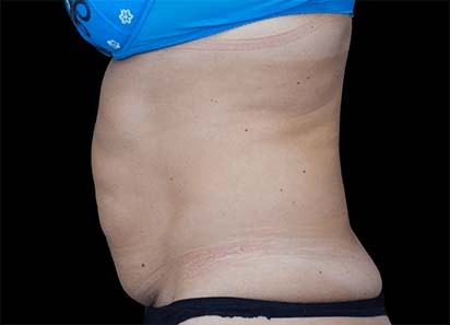 Emsculpt_PIC_022-Before-abdomen-female-Paula-Lozanova-MD_412x296px_1589359508_original