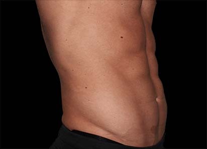 Emsculpt_PIC_036-After-abdomen-male-Edward-M-Zimmerman-MD-4TX_412x296px_1589358998_original