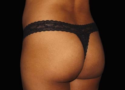 Emsculpt_PIC_036-After-buttock-female-Chris-Bailey-Ovation-Med-Spa-4TX__412x296px_1602658245_original