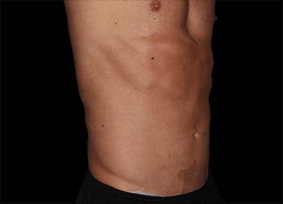Emsculpt_PIC_036-Before-abdomen-male-Edward-M-Zimmerman-MD_412x296px_1589359001_original