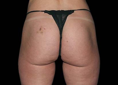 Emsculpt_PIC_041-After-buttock-female-Chris-Bailey-Ovation-Med-Spa-4TX__412x296px_1589434585_original_New