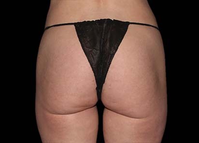 Emsculpt_PIC_041-Before-buttock-female-Chris-Bailey-Ovation-Med-Spa__412x296px_1589434587_original_New