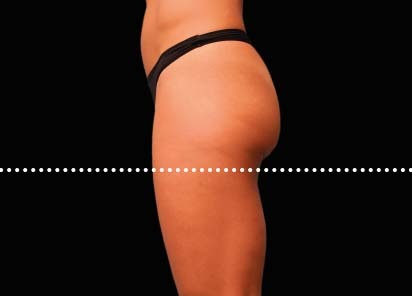 Emsculpt_PIC_042-After-buttock-female-Brian-Kinney-MD-4TX__412x296px_1589434589_original_New