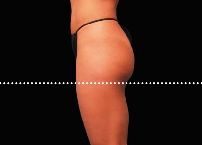 Emsculpt_PIC_042-Before-buttock-female-Brian-Kinney-MD__412x296px_1589434590_original_New