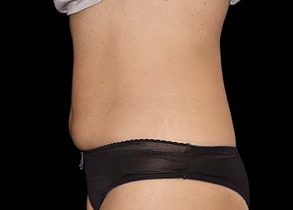 Emsculpt_PIC_045-after-female-Katia-Paskova-MD-4TX4W_412x296px_1589359003_original