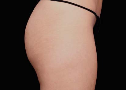 Emsculpt_PIC_049-After-buttock-female-Lasky-Aesthetics-4TX__412x296px_1602658249_original