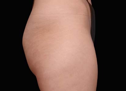 Emsculpt_PIC_049-Before-buttock-female-Lasky-Aesthetics__412x296px_1602658252_original