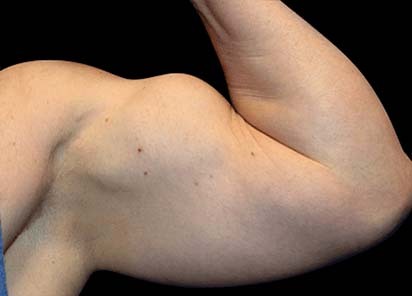 Emsculpt_PIC_074-after-arms-male-Reminder-Saluja-3W-4TX_412x296_1589434132_original_New