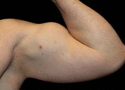 Emsculpt_PIC_074-before-arms-male-Reminder-Saluja-MD_412x296px_1589434134_original_New