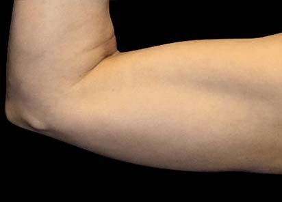 Emsculpt_PIC_075-After-arms-female-Reminder-Saluja-MD-3W-4TX_412x296_1589359091_original_New