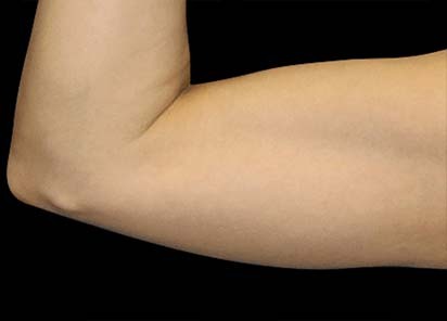 Emsculpt_PIC_075-Before-arms-female-Reminder-Saluja-MD_412x296_1589359093_original_New
