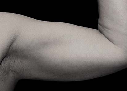 Emsculpt_PIC_076-After-arms-female-Reminder-Saluja-MD-3W-4TX__412x296px_1589434136_original_New