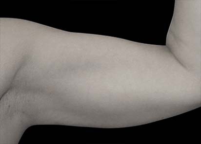 Emsculpt_PIC_076-Before-arms-female-Reminder-Saluja-MD__412x296px_1589434139_original_New