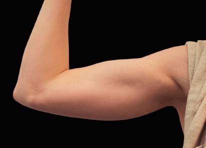 Emsculpt_PIC_078-After-biceps-female-Reminder-Saluja-MD-md-4TX__412x296px_1589434141_original_New