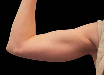 Emsculpt_PIC_078-After-biceps-female-Reminder-Saluja-MD-md-4TX__412x296px_1616750690_original_New