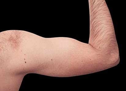 Emsculpt_PIC_079-after-biceps-male-Reminder-Saluja-MD-4TX_412x296_1589434144_original_New