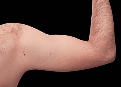 Emsculpt_PIC_079-before-biceps-male-Reminder-Saluja-MD-4TX_412x296_1589434145_original_New